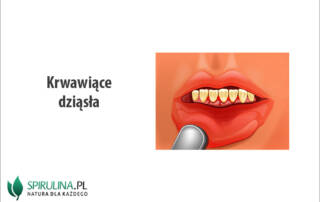 Krwawiące dziąsła