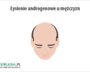 Łysienie androgenowe u mężczyzn