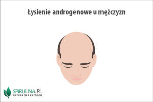 Łysienie androgenowe u mężczyzn
