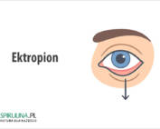 Ektropion