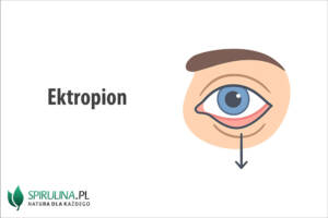 Ektropion