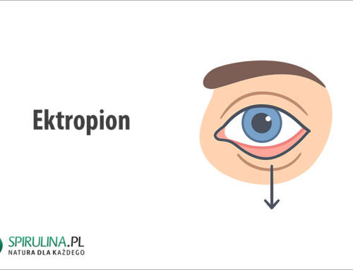 Ektropion