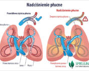 Nadciśnienie płucne