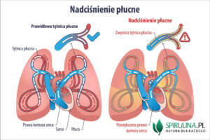 Nadciśnienie płucne