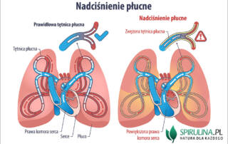 Nadciśnienie płucne