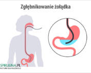 Zgłębnikowanie żołądka