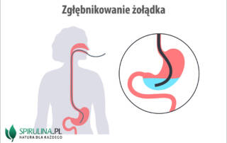 Zgłębnikowanie żołądka