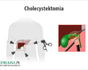 Cholecystektomia