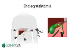 Cholecystektomia