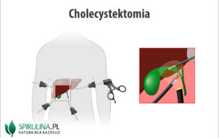 Cholecystektomia