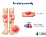 Rumień guzowaty