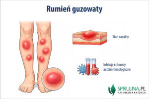 Rumień guzowaty