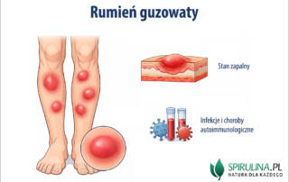 Rumień guzowaty