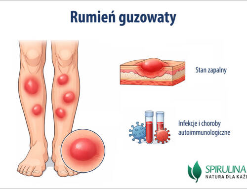 Rumień guzowaty