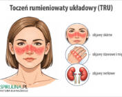 Toczeń rumieniowaty układowy (TRU)
