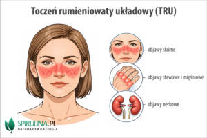 Toczeń rumieniowaty układowy (TRU)