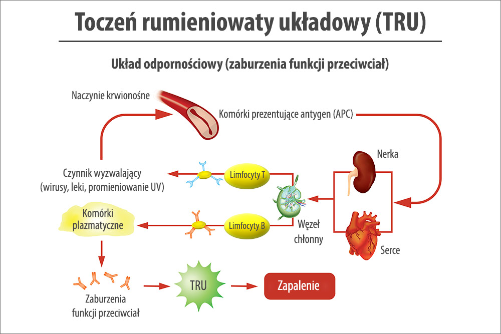 Toczeń rumieniowaty układowy