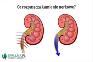 Co rozpuszcza kamienie nerkowe?