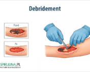 Debridement