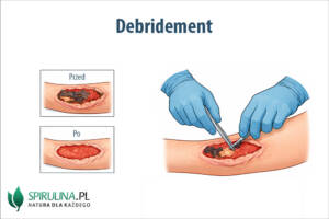 Debridement