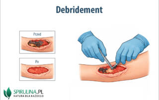 Debridement