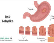 Rak żołądka