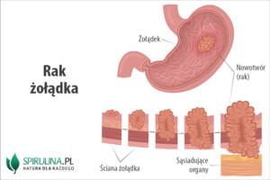 Rak żołądka