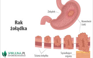 Rak żołądka