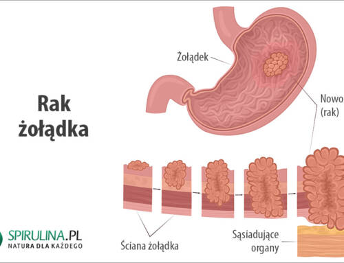 Rak żołądka