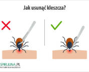 Jak usunąć kleszcza?
