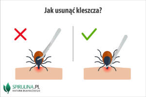 Jak usunąć kleszcza?