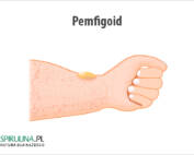 Pemfigoid