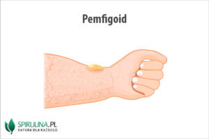 Pemfigoid