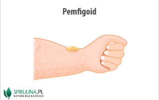 Pemfigoid