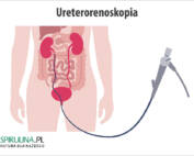 Ureterorenoskopia