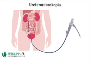 Ureterorenoskopia