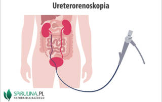 Ureterorenoskopia