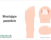 Wrastające paznokcie