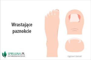 Wrastające paznokcie
