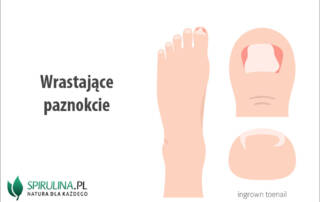 Wrastające paznokcie
