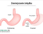 Zmniejszanie żołądka