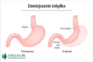 Zmniejszanie żołądka