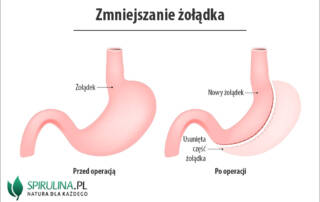 Zmniejszanie żołądka