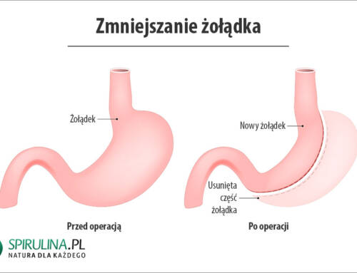 Zmniejszanie żołądka