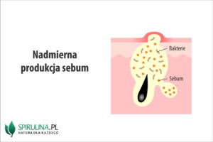 Nadmierna produkcja sebum