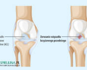 Zerwanie więzadła krzyżowego przedniego