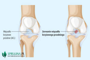 Zerwanie więzadła krzyżowego przedniego