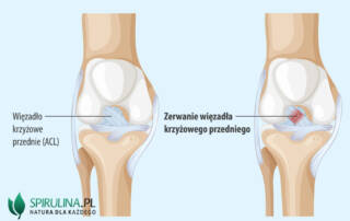 Zerwanie więzadła krzyżowego przedniego