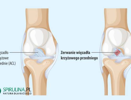 Zerwanie więzadła krzyżowego przedniego