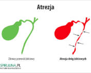 Atrezja